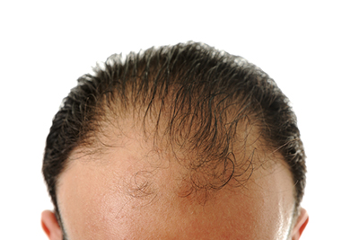 Man showing visible signs of hair thinning or balding